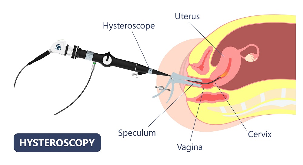 histeroscopia