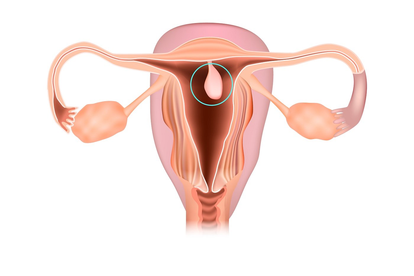 Pólipos uterinos