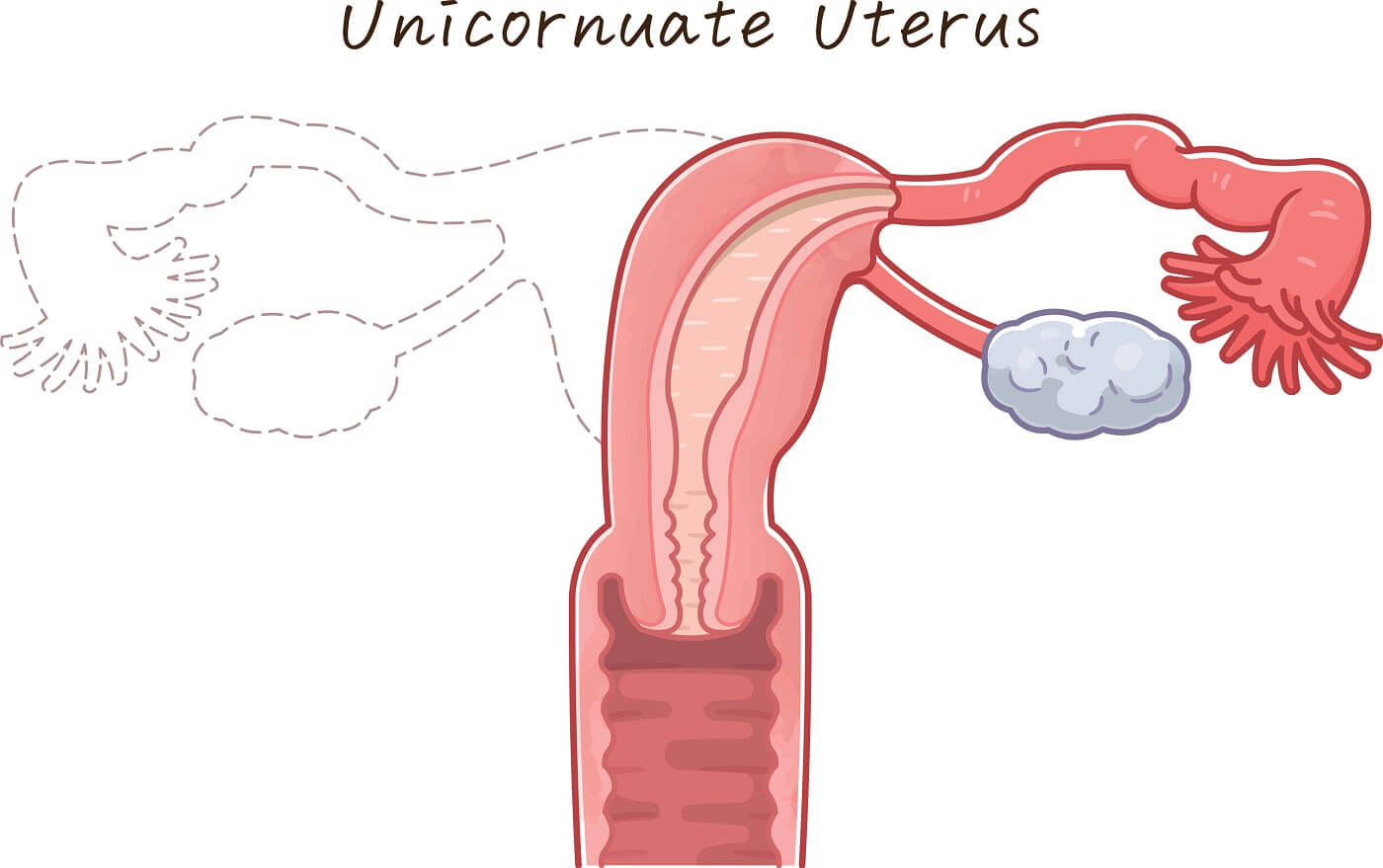 utero unicorne